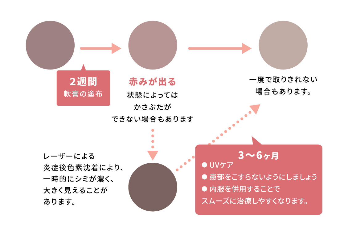 ミセルクリニック岸和田院（ただおかメディカルクリニック併設美容皮膚科）のシミ取り放題後の経過とアフターケア