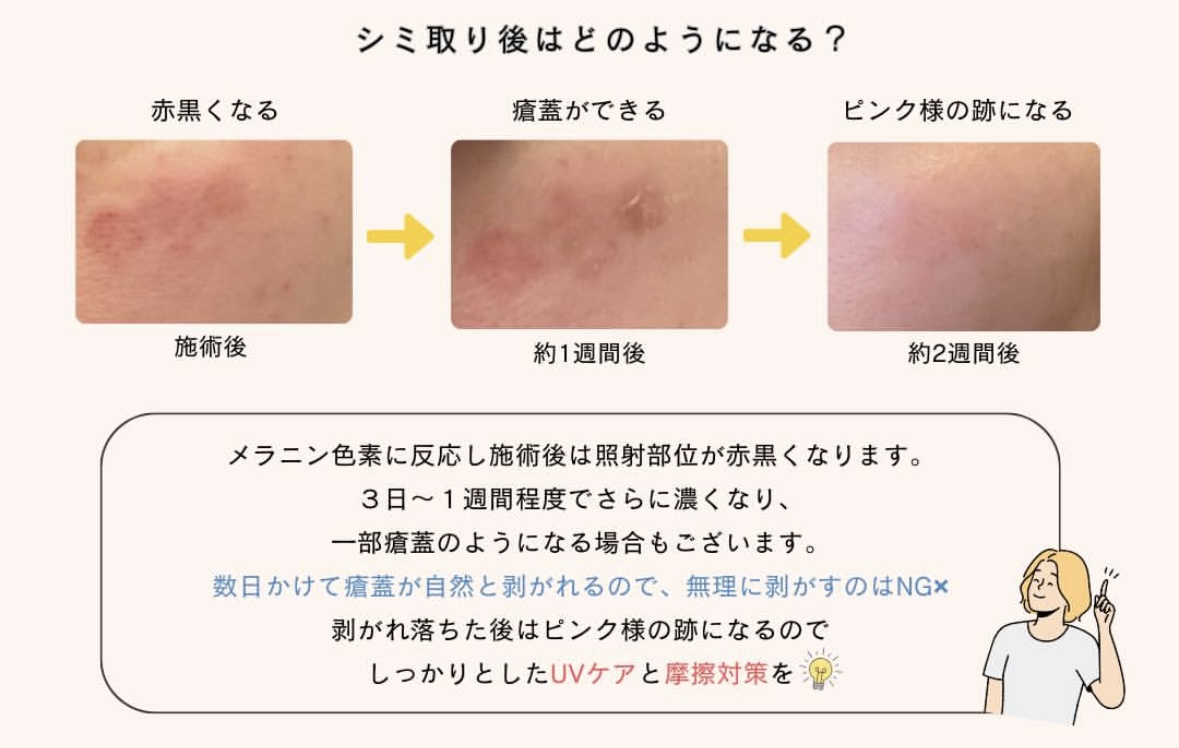 レーザーでのシミ取り後の経過をまとめた画像。施術後は照射部位が赤黒くなり、3日~1週間程度で更に濃くなり、一部かさぶたのようになる場合もある。数日かけてかさぶたが自然と剥がれるので剥がすのはNG、剥がれ落ちたらピンク色の跡になるのでUVケアと摩擦対策を欠かさないこと、が写真とテキストで表されている。